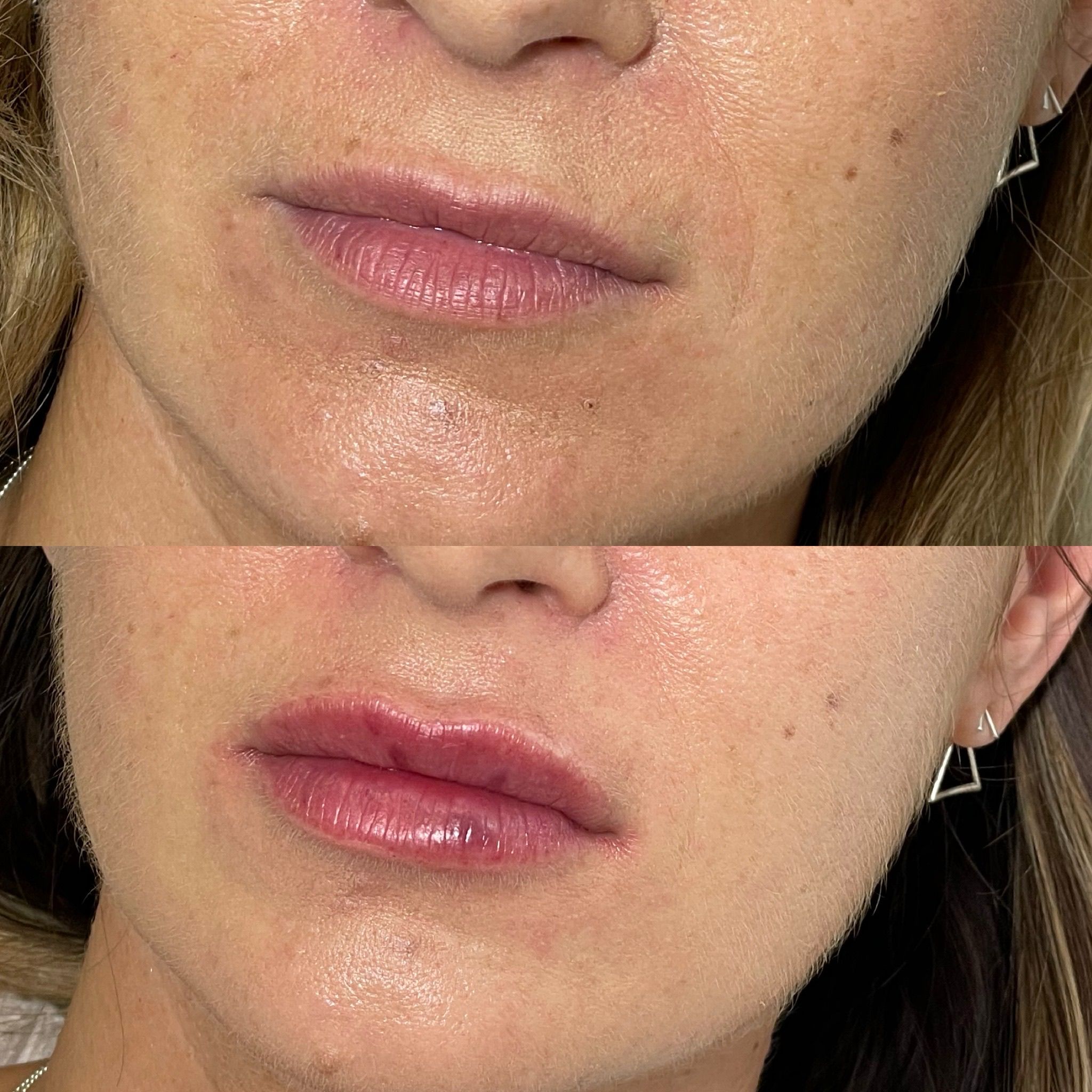 Lip Fillers, Botox, Dermal Fillers, Anti-Wrinkle Injections in Camden NW3 post thumbnail image